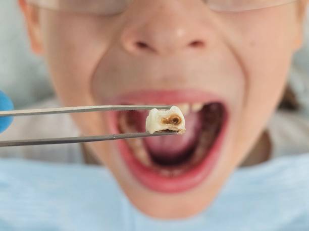 Best Urgent Dental Care for Toothache in Pearl River, NY